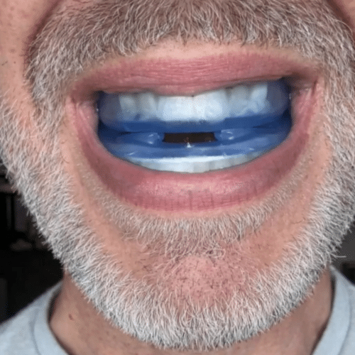 Feliora Anti-Snoring Mouthpiece (Buy 1 Get 1 Free)